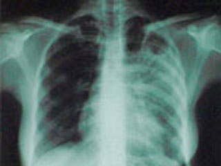 туберкулез